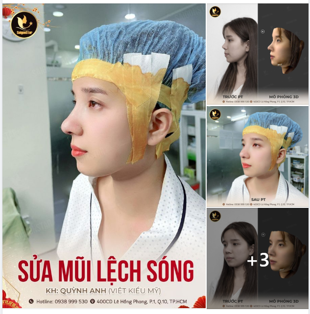 SỬA MŨI LỆCH SÓNG – ĐÓN XUÂN TRỌN VẸN
