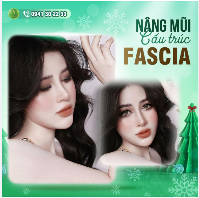 FEEDBACK CỦA CÔ NÀNG MỸ MỸ SAU 1 THÁNG NÂNG MŨI