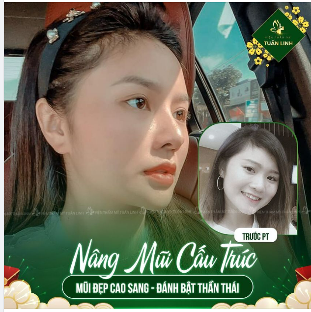 Vẫn là gương mặt ấy, nhưng TẾT này đã có mũi xinh lung linh hơn nhiều!!