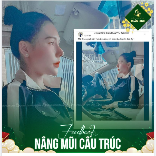 Feedback nâng mũi ngày gần TẾT!!