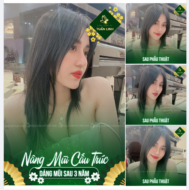 Nâng mũi cấu trúc - Dáng mũi Angel line cao tự nhiên sau 3 năm nâng tại Tuấn Linh