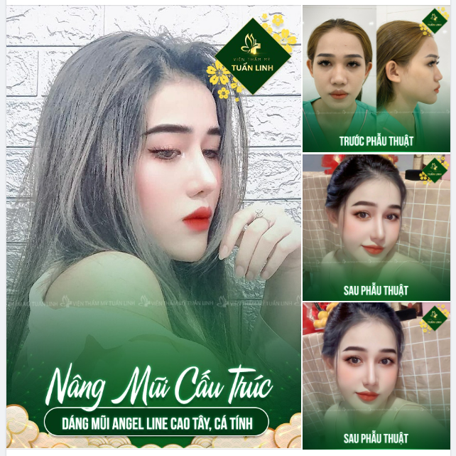 Mũi gãy, mũi gồ, mũi thấp tẹt, to bè... Đừng buồn, đã có nâng mũi cấu trúc tại Tuấn Linh!