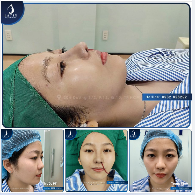 MŨI CẤU TRÚC SỬA LẠI