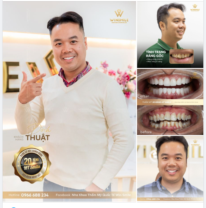 DÁNG RĂNG MẠNH MẼ ĐẦY NAM TÍNH NHỮNG VẪN GIỮ NGUYÊN NÉT TỰ NHIÊN