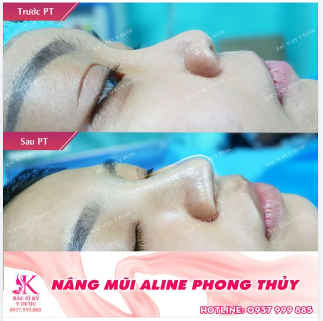 MŨI XINH - TỰ TIN LÀ CHÍNH MÌNH
