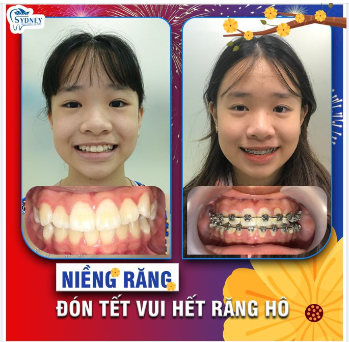 Niềng răng đón Tết – Vui hết răng hô