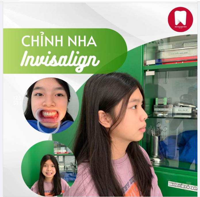 CƯỜI TƯƠI DUYÊN DÁNG – ĐÓN TẾT RẠNG NGỜI CÙNG INVISALIGN