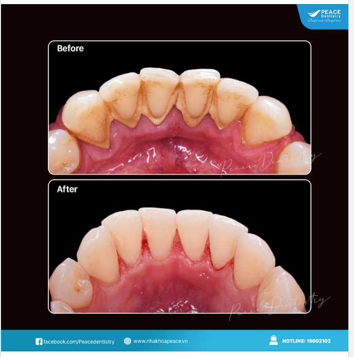 Cuối năm chính là thời điểm hợp lý bạn nên cạo vôi răng để có một nụ cười tự tin, rạng rỡ đón chào năm mới thật tươi vui và hạnh phúc.