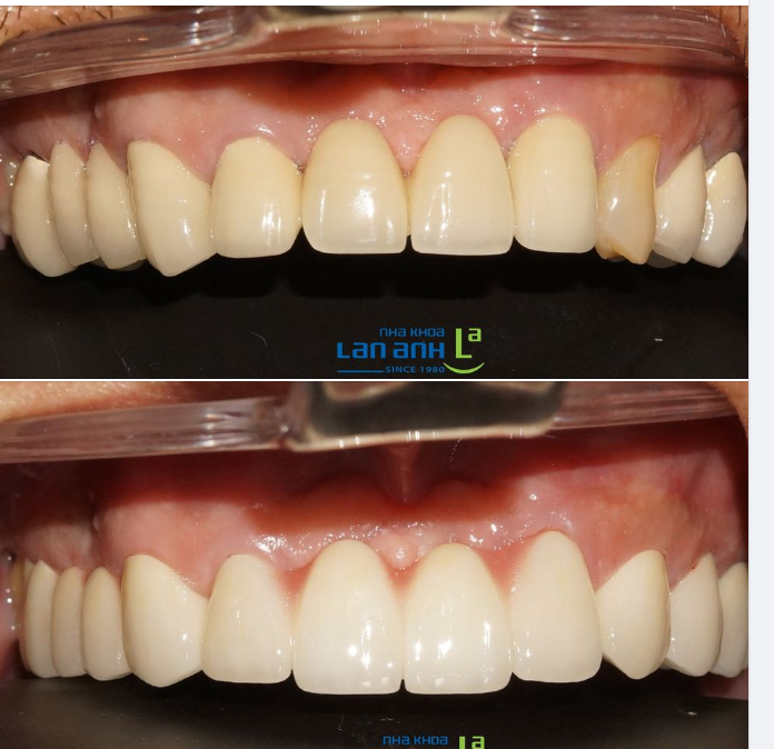  Một ca làm lại răng sứ của bác sĩ Tài, chi nhánh Tôn Dật Tiên, Q.7!