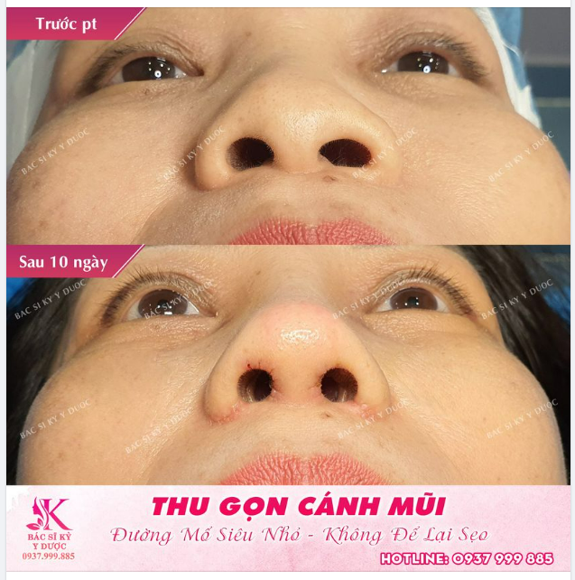 Thu gọn cánh mũi không khó  Cứ để Bác sĩ Kỳ Y Dược lo.