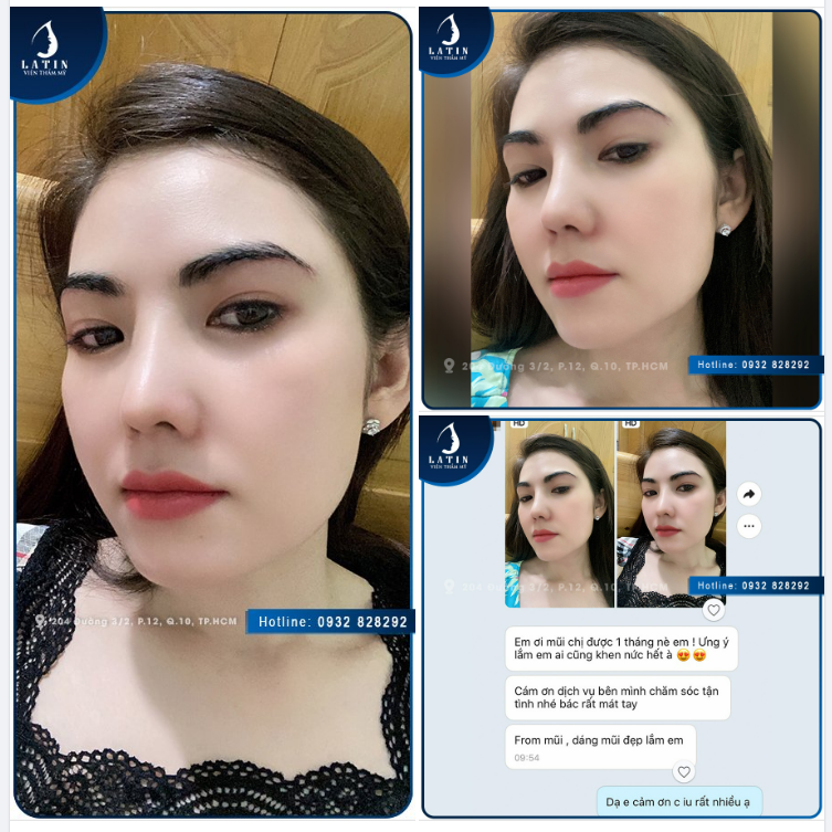 ĐẸP LUNG LINH SAU 1 THÁNG LÀM COMBO DỊCH VỤ TẠI LATIN