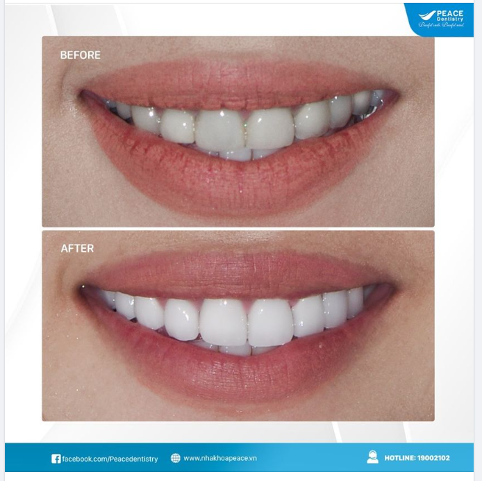 Thay răng sứ cũ “đổi” diện mạo mới cho nữ khách hàng Việt Kiều Mỹ về nước đón Tết cùng gia đình.
