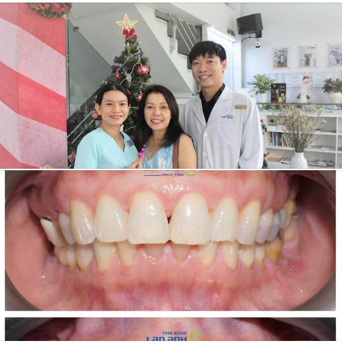 Sẵn khoe răng sứ mới của chị, với sự đồng hành của bs Tùng- chi nhánh 130 Hà Huy Tập