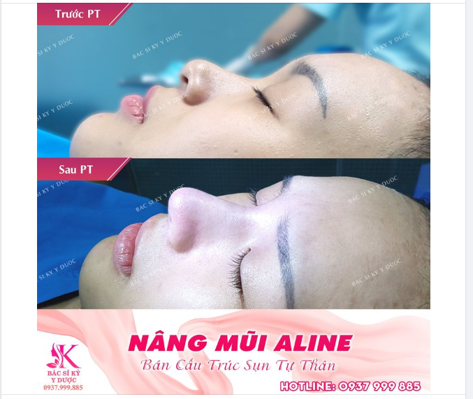 Nâng mũi ALINE bán cấu trúc