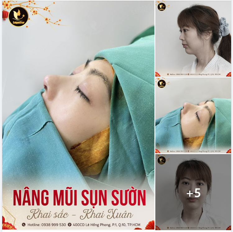 NÂNG MŨI SỤN SƯỜN | KHAI SẮC – KHAI XUÂN