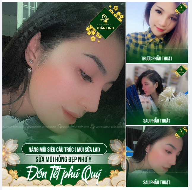 SỦA MŨI HỎNG ĐẸP NHƯ Ý ĐÓN NĂM MỚI PHÚ QUÝ