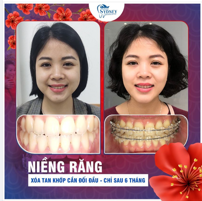 Niềng răng xóa tan khớp cắn đối đầu – không còn ưu sầu khi Tết đến