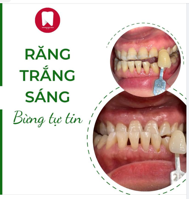 "TUYỆT CHIÊU" GIÚP RĂNG TRẮNG SÁNG AN TOÀN - TỰ TIN ĐÓN TẾT