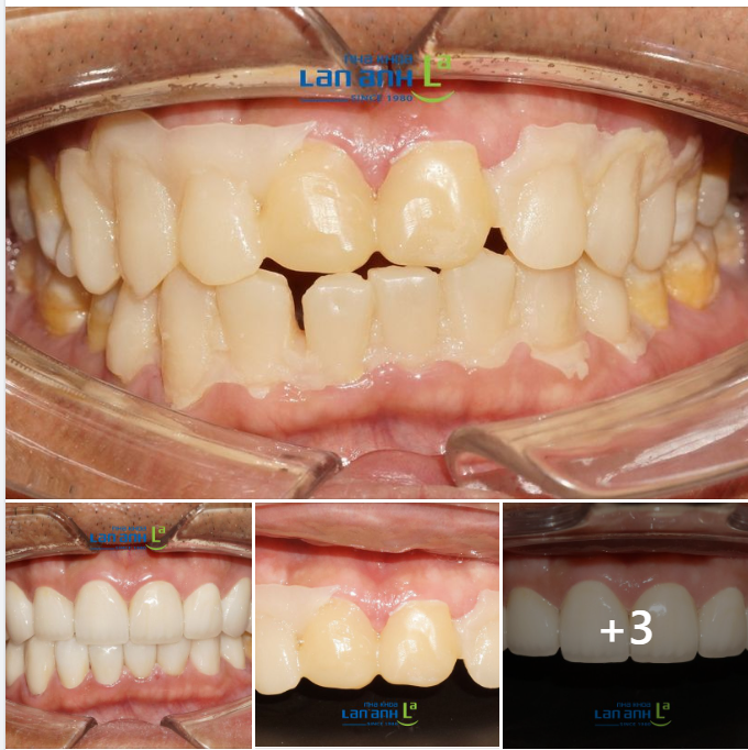 Một ca phục hình răng sứ của bác sĩ Bảo Lan, chi nhánh Tôn Dật Tiên, Q.7!