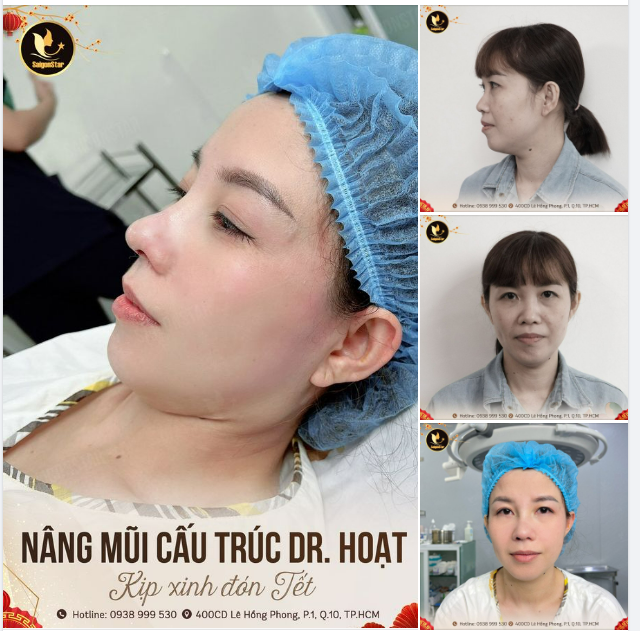 NÂNG MŨI CẤU TRÚC DR. HOẠT️ KỊP XINH ĐÓN TẾT