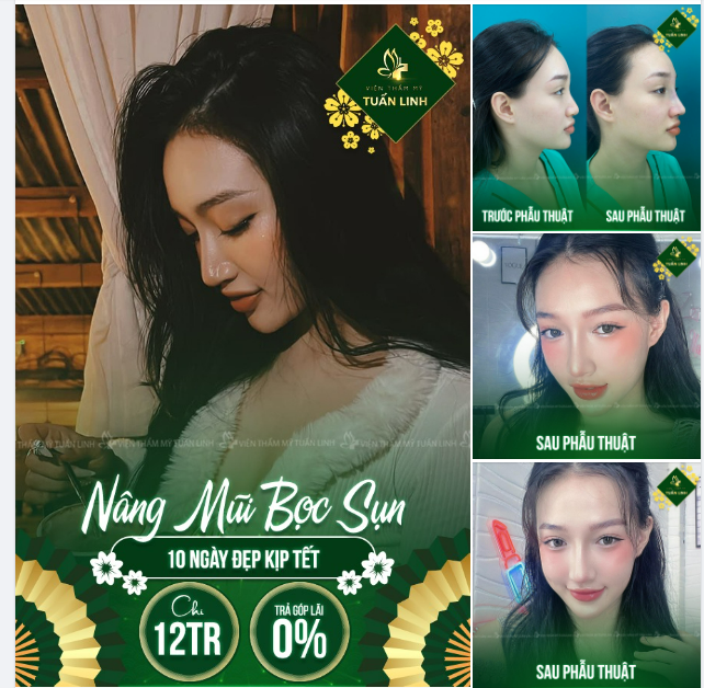 NÂNG MŨI BỌC SỤN - GIÁ SIÊU YÊU CHỈ 12TR
