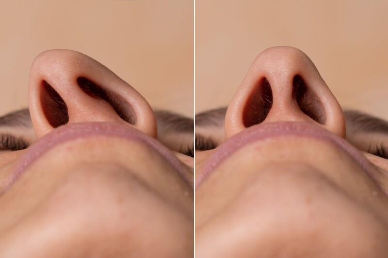 Chi tiết cách chăm sóc sau mổ vẹo vách ngăn mũi