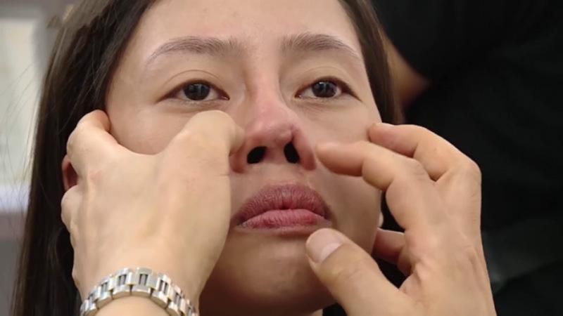 Mổ vẹo vách ngăn mũi khắc phục vấn đề nâng mũi bị lệch
