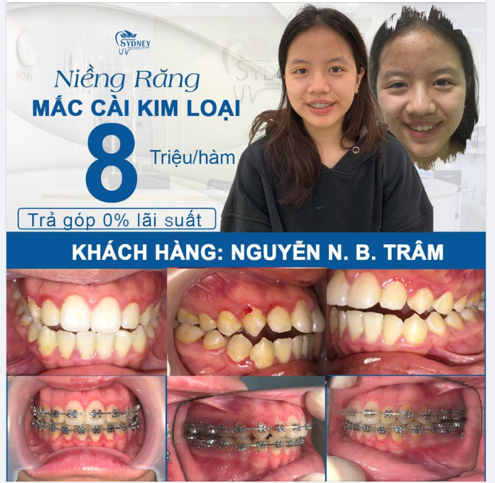 Khắc phục tình trạng sai lệch khớp cắn ngay hôm nay chỉ 8tr/hàm