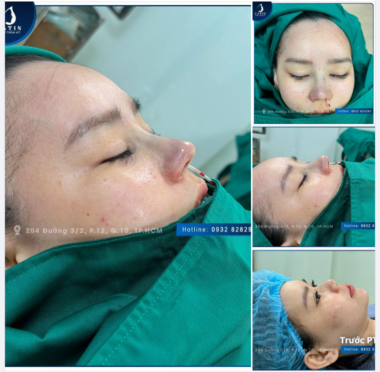 Biến hình ngoạn mục sau nâng mũi bán cấu trúc cho bạn gái đến từ An Giang