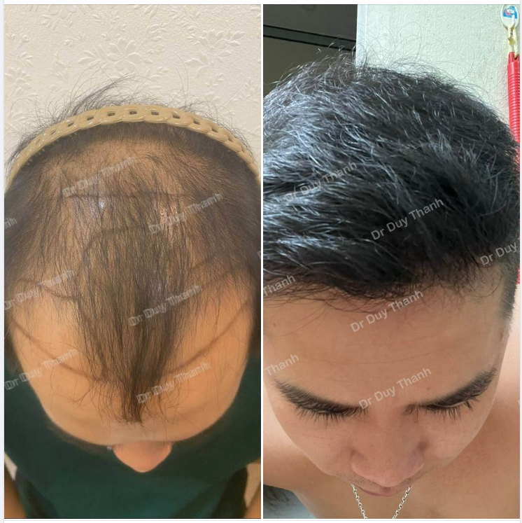 "CHOÁNG VÁNG" VỚI KẾT QUẢ SAU 6 THÁNG CẤY 1900 NANG TÓC
