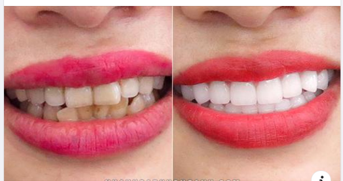 5 Cách Xóa Bỏ Nổi Lo Về Vấn Đề Hôi Miệng