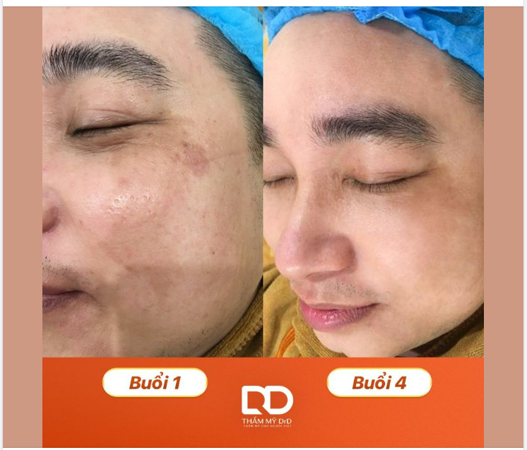TRỊ NÁM DA CHO NAM GIỚI CÓ KHÁC NỮ GIỚI KHÔNG?