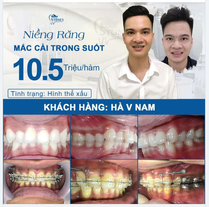 4 ưu điểm nổi trội giúp niềng răng mắc cài pha lê chinh phục mọi nụ cười