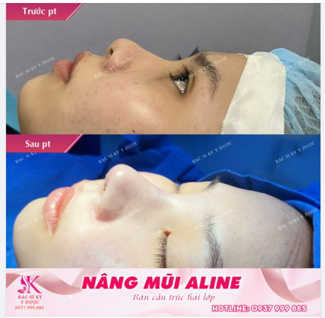 Tự tin khác biệt cùng dáng mũi ALINE nhẹ nhàng tự nhiên