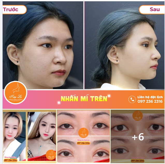 CHỈ 45' SỞ HỮU MÍ ĐẸP TRỌN ĐỜI - RẠNG NGỜI MỌI LÚC