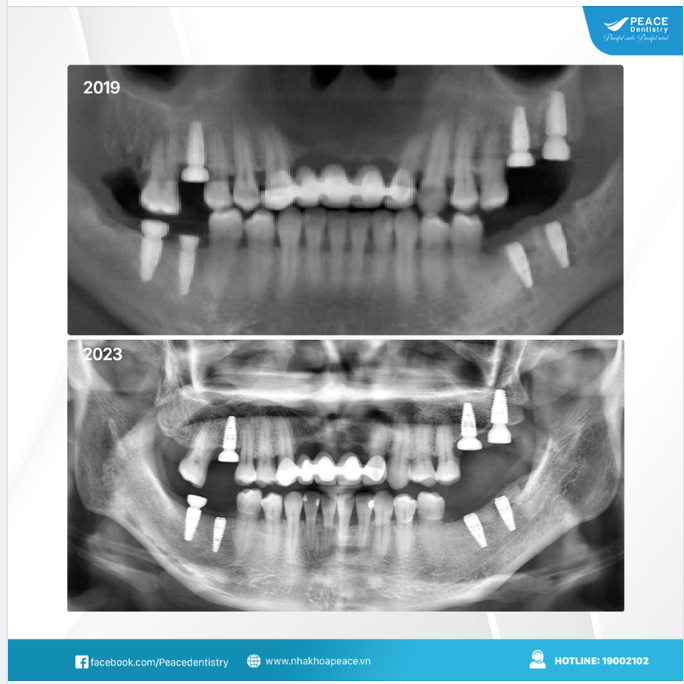 Peace Dentistry xin phản hồi đến quý khách hàng Việt Kiều có thể hoàn toàn yên tâm: