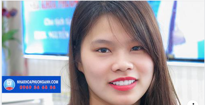 Bọc răng sứ thẩm mỹ thay đổi nụ cười