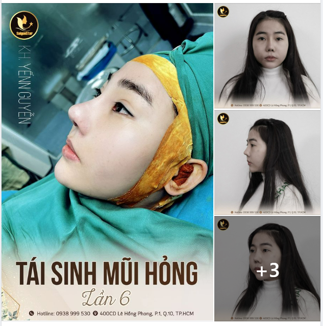NÂNG MŨI SỬA LẠI - TÁI SINH MŨI HỎNG