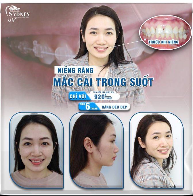 Niềng răng có thật sự làm thay đổi khuôn mặt?
