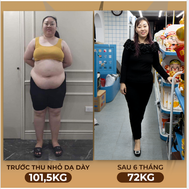 Kết quả của bệnh nhân là minh chứng xác thực nhất cho hiệu quả của phương pháp phẫu thuật thu nhỏ dạ dày !