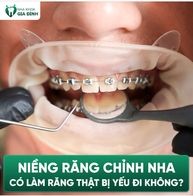 NIỀNG RĂNG CÓ THẬT SỰ KHIẾN RĂNG BỊ YẾU ĐI KHÔNG?