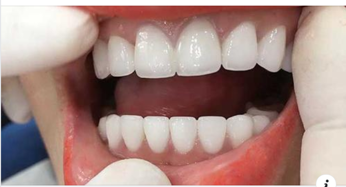 So Sánh Hàm Giả Tháo Lắp Và Trồng Răng Implant