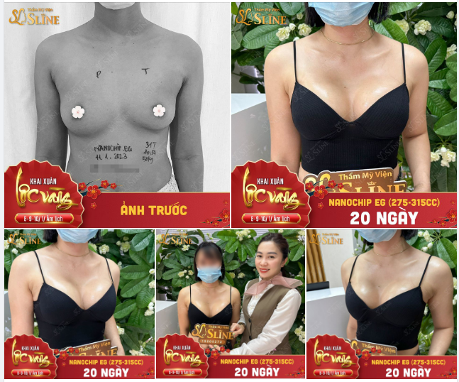 NGỰC ĐẸP SAU 20 NGÀY TUỔI,