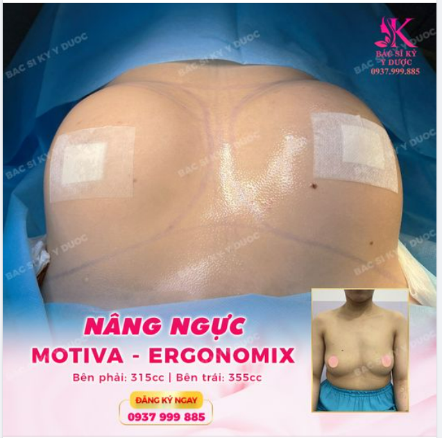 Chiêm ngưỡng kết quả nâng ngực ERGONOMIX tại Bác sĩ Kỳ Y Dược.