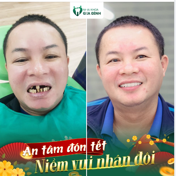 RĂNG ĐẸP KHỎE MẠNH - ĐÓN TẾT TRỌN NIỀM VUI