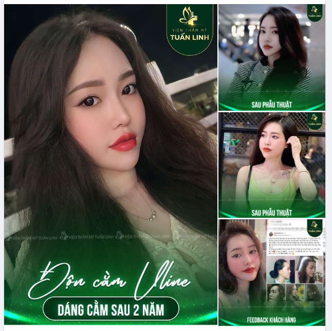 Cằm ngắn, lẹm làm khuôn mặt bạn bị hô... Độn cằm Vline như cô gái này ngay nhé!