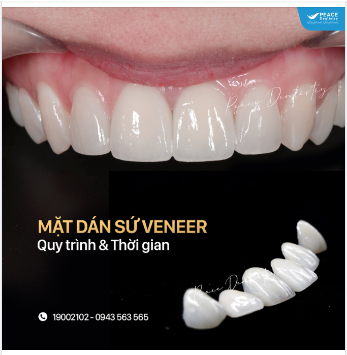 QUY TRÌNH  THỜI GIAN HOÀN THÀNH MỘT CA  MẶT DÁN SỨ VENEER