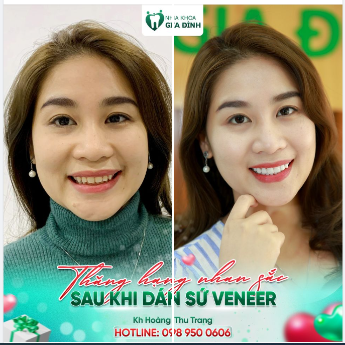 Dán sứ Veneer – Phương pháp giúp nụ cười tỏa sáng, an toàn khi thực hiện