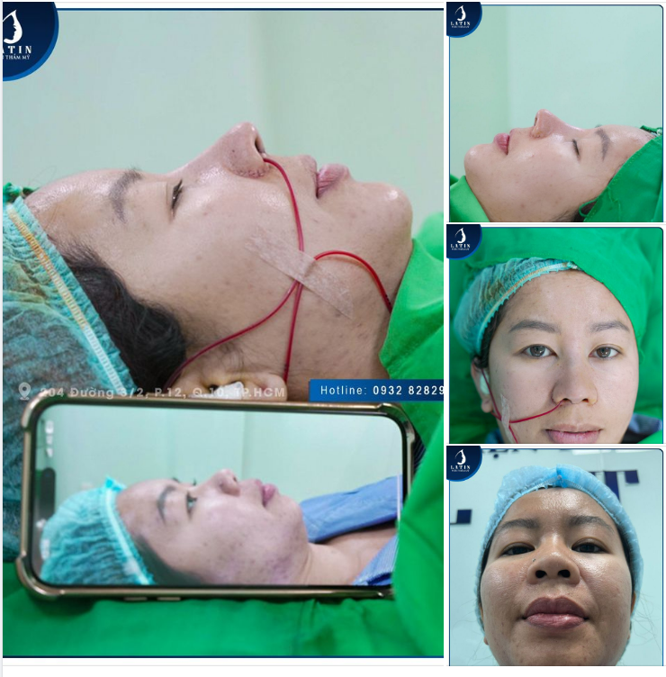 Kết quả combo dịch vụ nâng mũi + độn cằm ngày hôm nay tại Latin