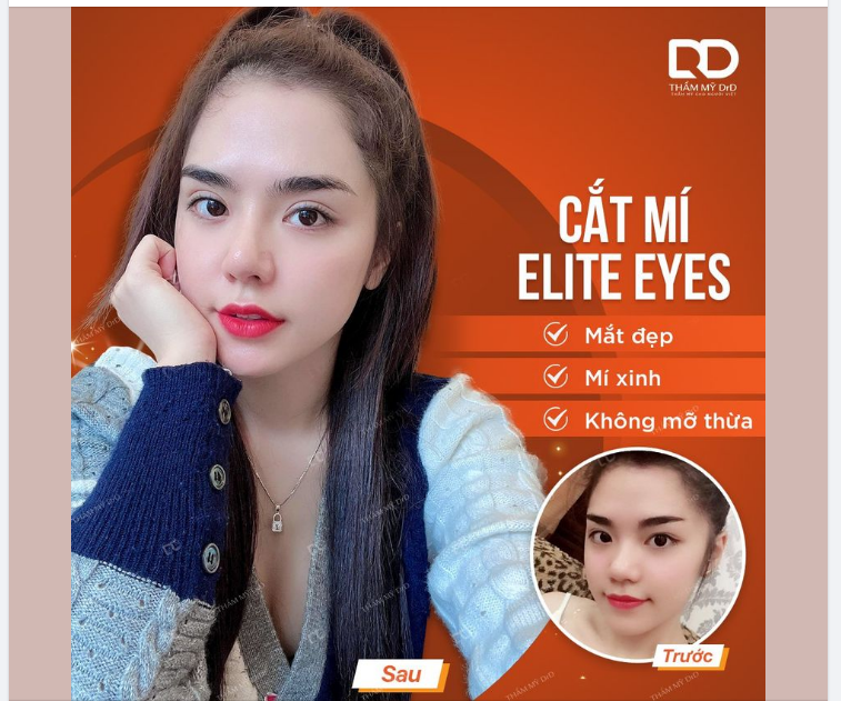 Muốn cho đôi mắt sắc sảo đâu có gì khó . Chỉ cần có cắt mí Elite Eyes